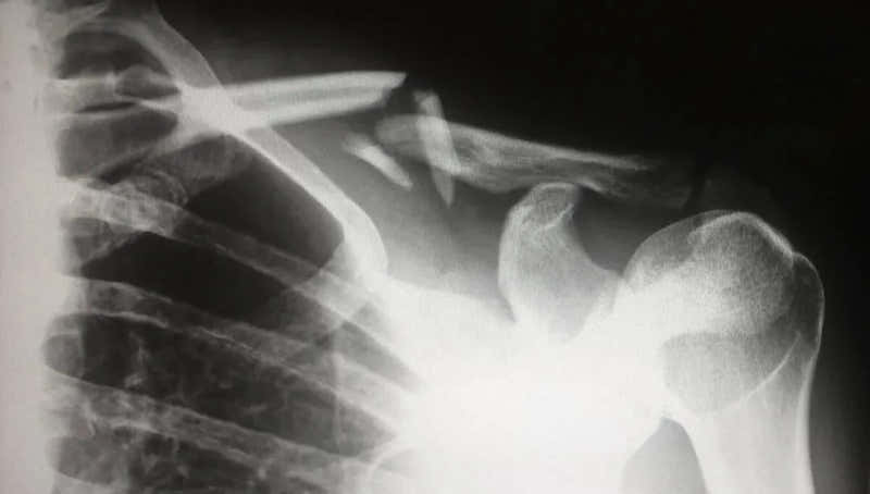 Why Most Sports Injuries Happen