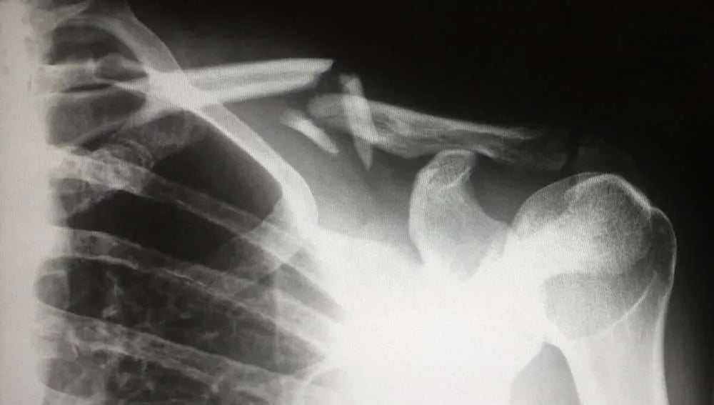 Why Most Sports Injuries Happen